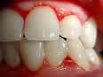 infiammazione gengivale studi dentistici di qualità roma centri dental