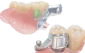Alternativa impianti dentali 