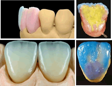 Ceramiche dentali zirconio di qualità 
Roma.Centri Dental.it