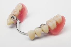 studi dentistici centri dental studi dentistici di qualità Roma protesi parziale scheletrica con attacchi