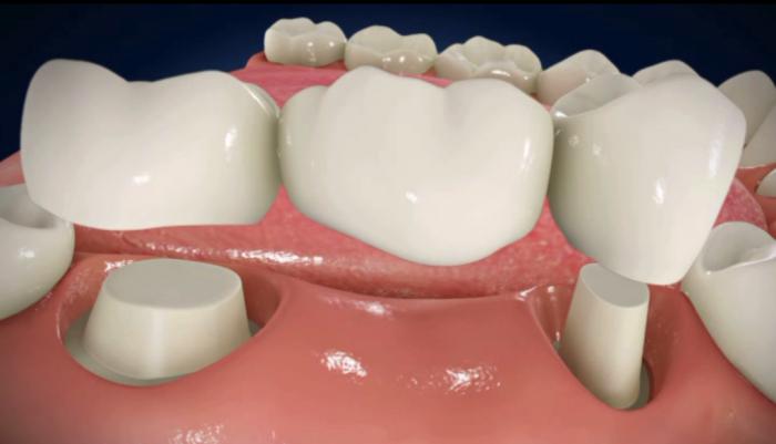 studi dentistici di qualità Roma Centri Dental corone in zirconio