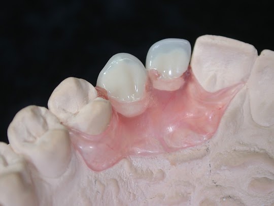 studi dentistici di qualità Roma Centri Dental.it ponti dentali non invasivi