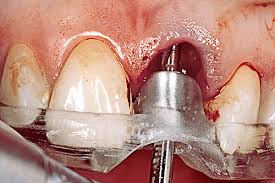 impianti dentali di qualità quali rischi si corrono 