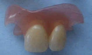ponti dentali non invasivi