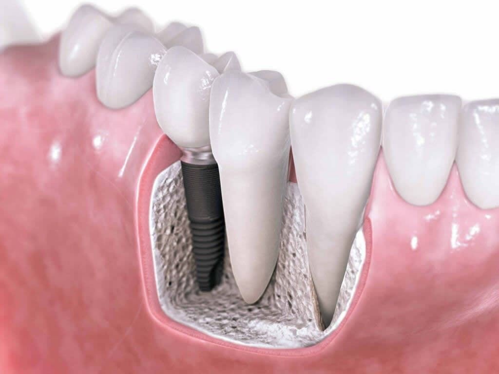 sudi dentistici di qualità  Roma implantologia non invasiva