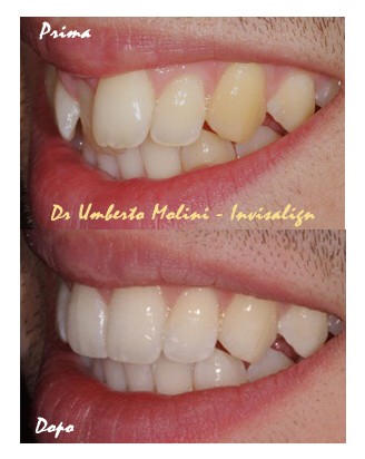 dentista allineamento denti con apparecchio invisibile